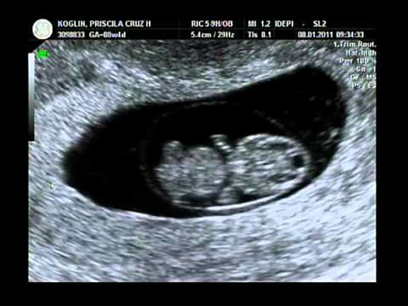 Como está o bebê com 9 semanas de gravidez | Blog da LVBB